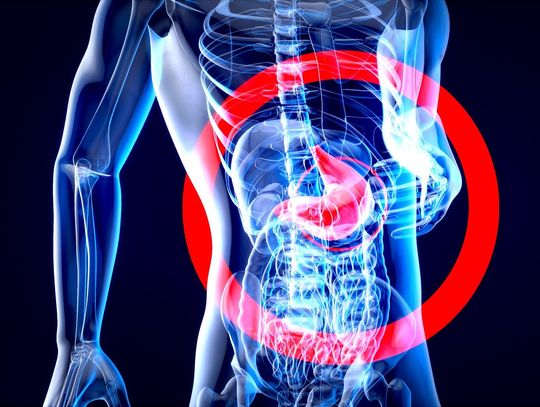 Czym jest refluks i skąd się bierze?