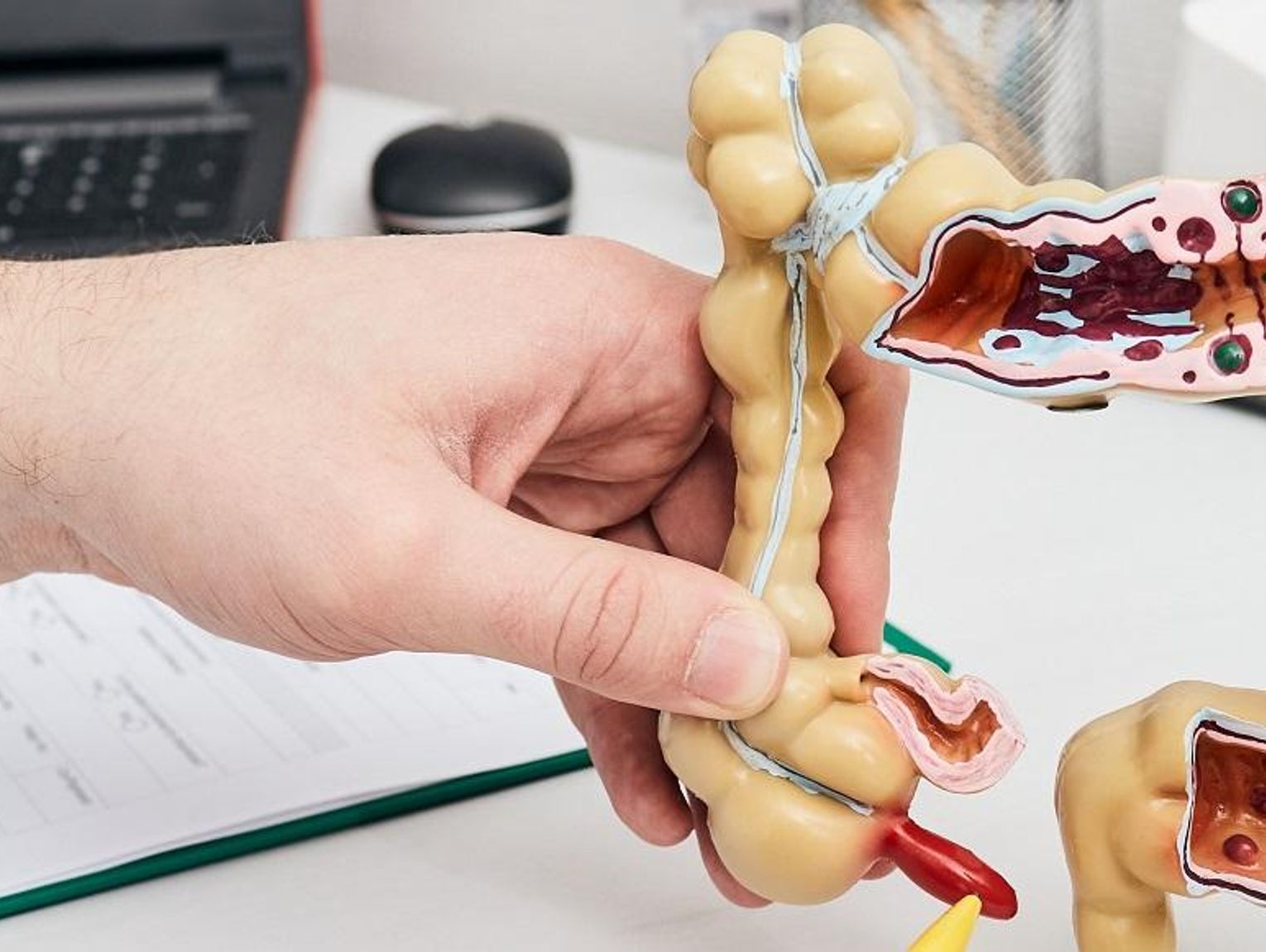 NOWOTWÓR WYKRYTY NA WCZESNYM ETAPIE MOŻE BYĆ CAŁKOWICIE WYLECZALNY